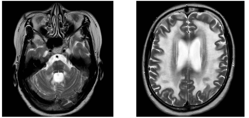 ADLDの頭部MRI