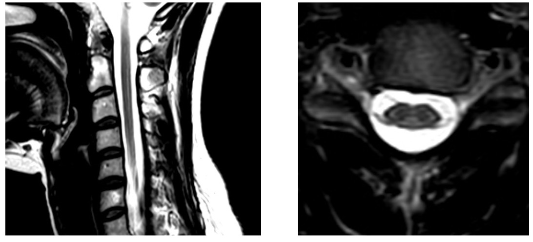 ADLDの脊椎MRI